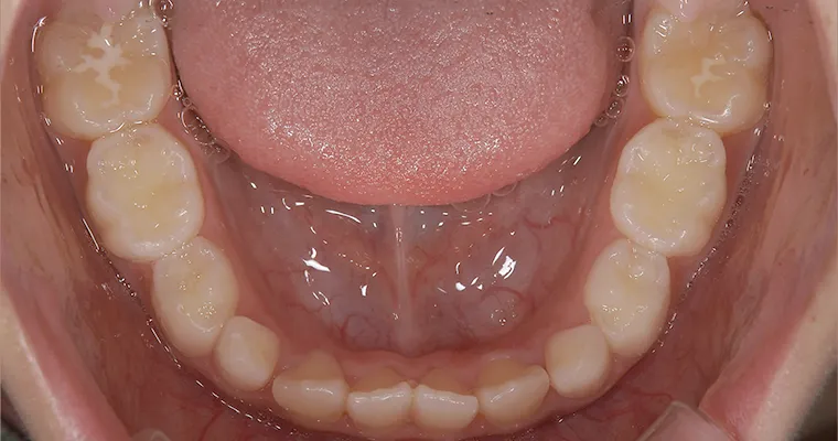 幼少期から反対咬合