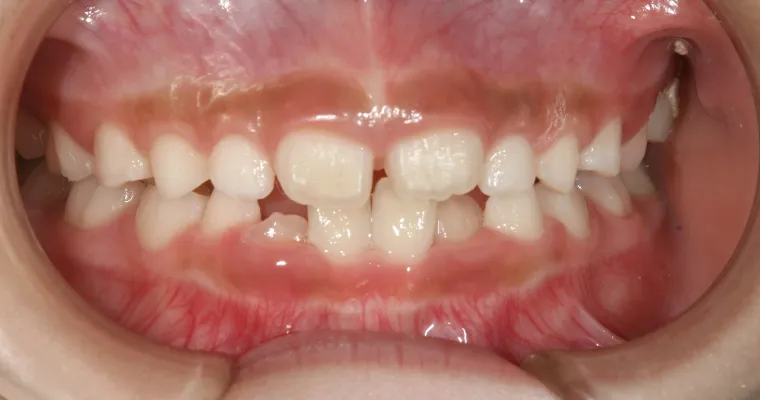 幼少期から反対咬合