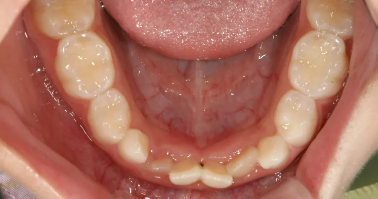 幼少期から反対咬合