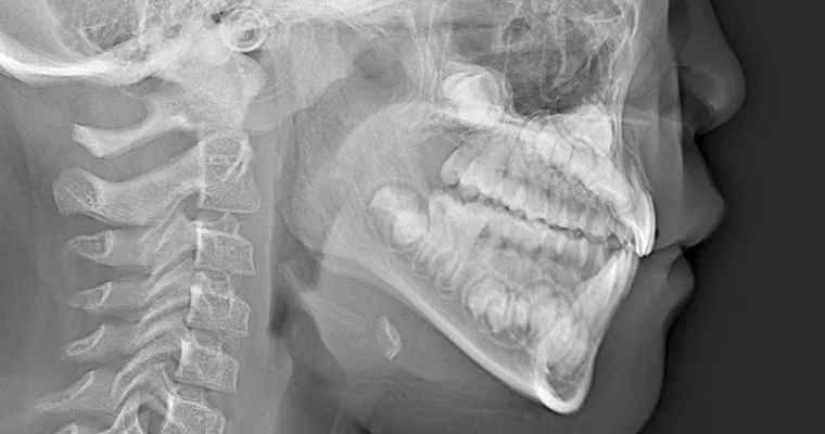 セファロレントゲン