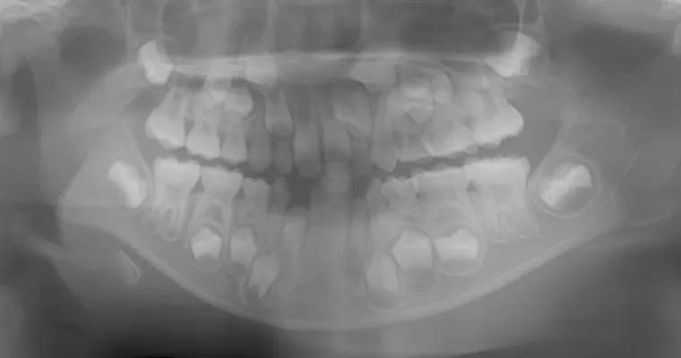 パノラマレントゲン