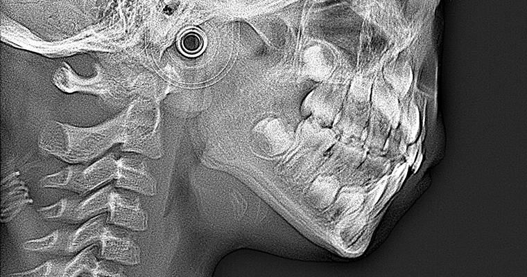 セファロレントゲン