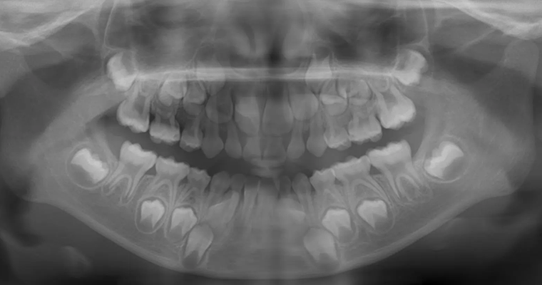 パノラマレントゲン