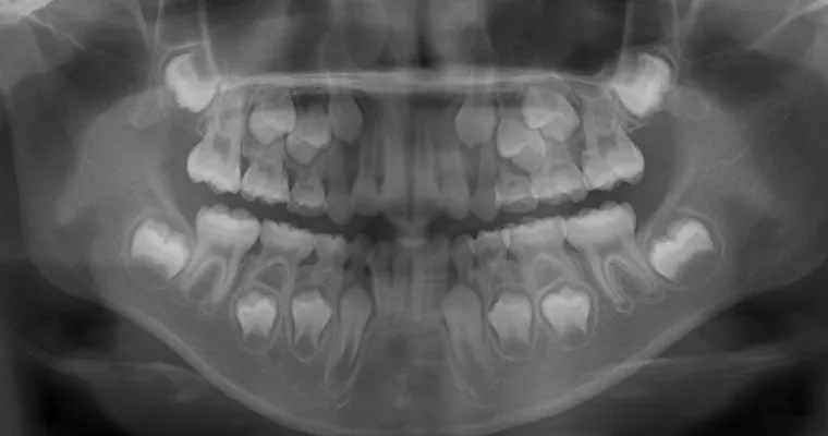 パノラマレントゲン