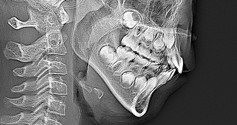 セファロレントゲン