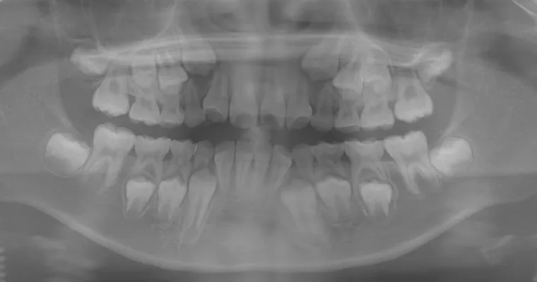 パノラマレントゲン