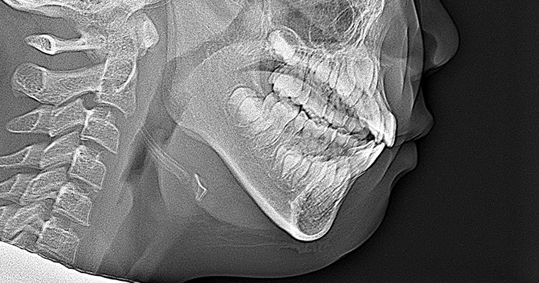 セファロレントゲン